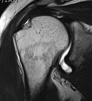 Supraspinatous articular sided tear